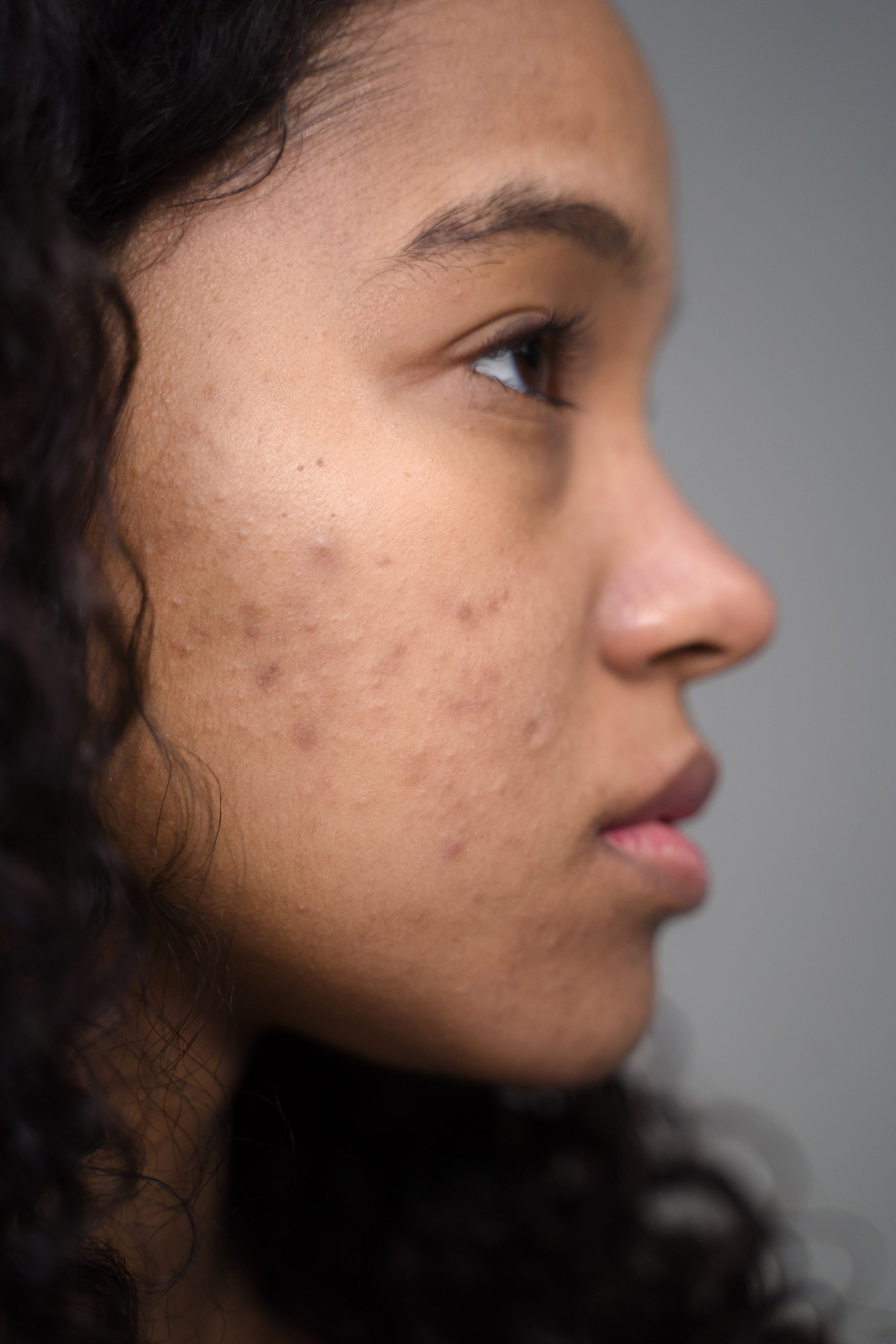 Finding Solutions for Acne by Wellness Minneapolis